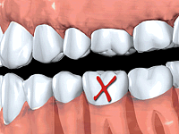 牙齿缺失的危害具体有多大？
