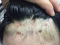 湖南丨害怕！11岁女孩拔自己头发致头皮发炎，医生：一种精神性疾病！
