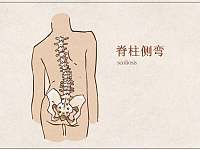 90岁老人的腰椎是什么样？退变性脊柱侧弯需要警惕
