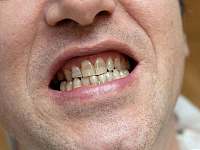普通来说，老年人几岁才开端掉牙？如何避免老掉牙？